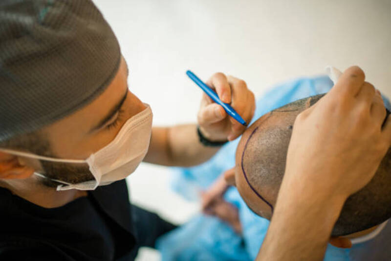 Best Hair Transplant Options and How to Finance Them