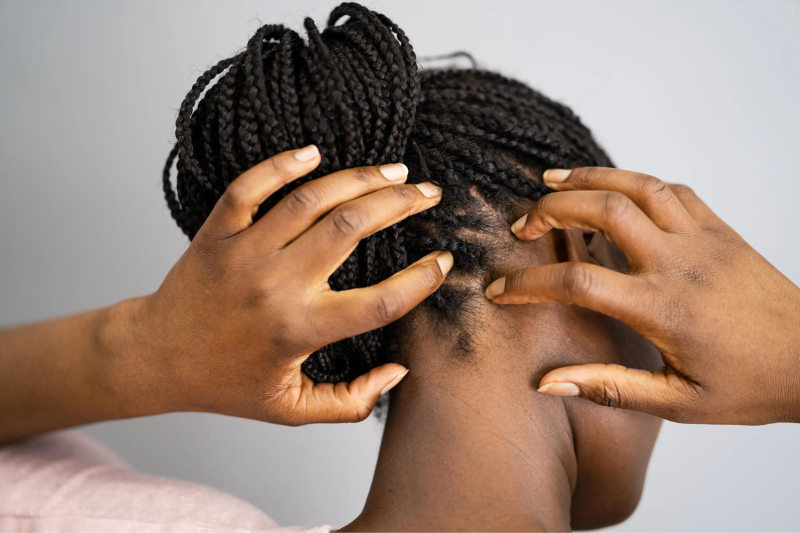 Can Black People Get Lice? The Truth Behind the Myth