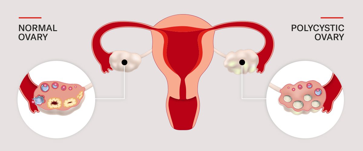 PCOS - Moving Beyond Just the Ovaries